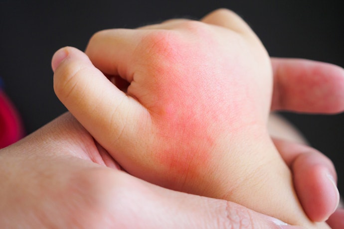 Materiais Como Látex e Ftalatos Podem Causar Alergias no Bebê